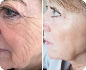 wrinkle reduction laser treatment